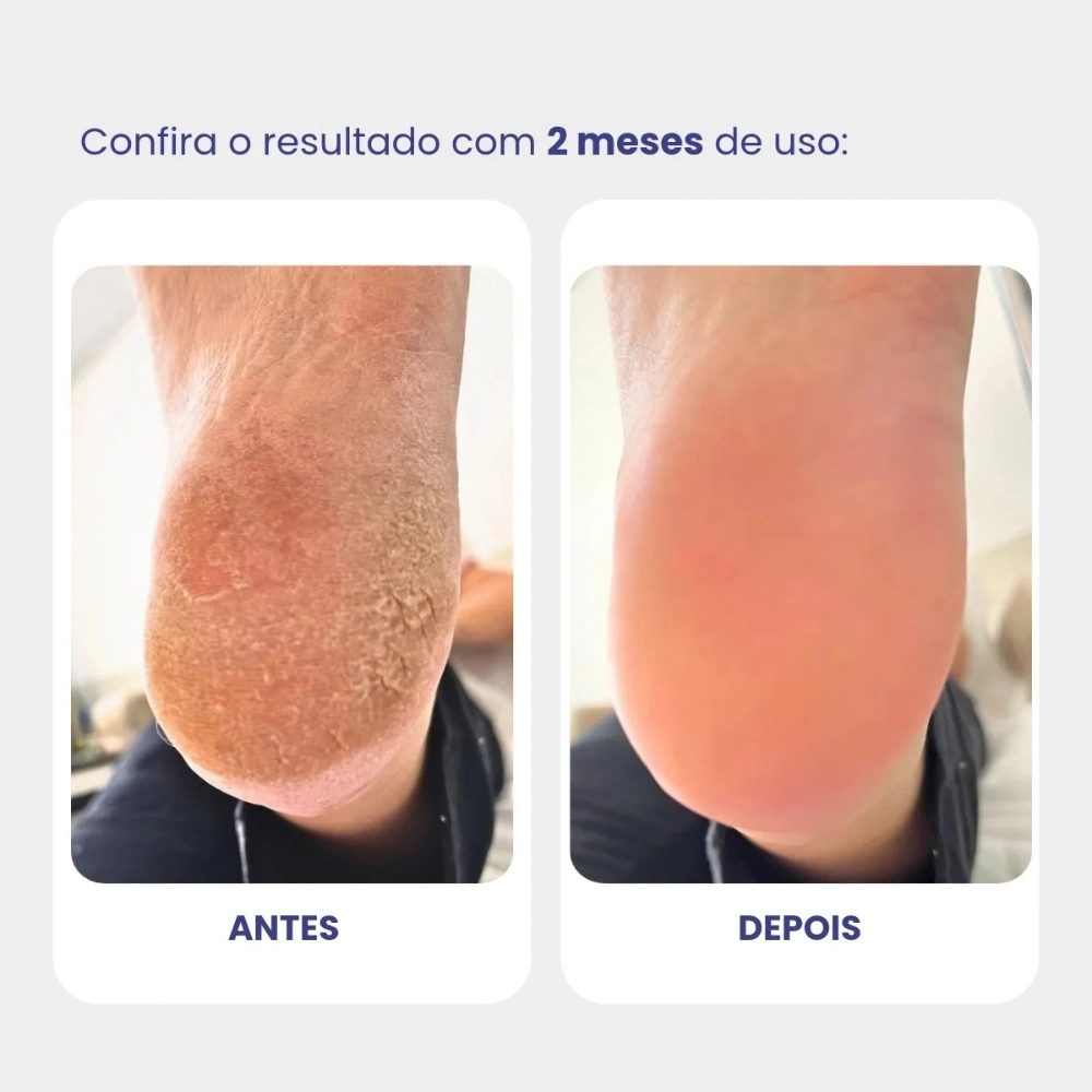 Creme Ultra Hidratante Homeopast 30g, ideal para hidratação intensiva e cuidados diários com a pele, ajudando a manter a pele macia, protegida e bem hidratada.