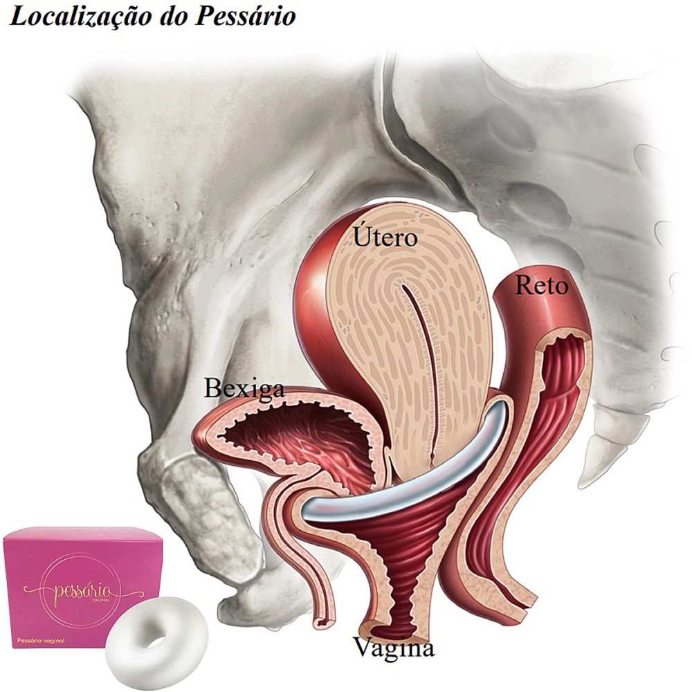 Pessário Uterino Tipo Donut Prolapso Vaginal Kolpast